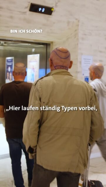Since yesterday in the ARD media centre: the new season of „Bin ich schön?“ 🎥This is the third time I've had the honour of accompanying the NDR documentary series as an aesthetic and plastic expert. Together with psychologist Dr Julia Tanck, we classify the cases shown medically, emotionally and socially - in a differentiated, honest way and without quick judgements. My dear colleague Dr Pirkko Schuppan from Cologne is also taking part. She is treating Sabine, who had a scar treated with hyaluronic acid following a serious facial injury caused by a dog bite and also had more volume injected into her lips at the same time. However, she did not feel comfortable with the result and finally found professional help from Dr Schuppan:▫️ Breast Implant Illness (BII) ▫️ Lipoedema ▫️ Gynaecomastia ▫️ Hair transplants ▫️ Brazilian Butt Lift (BBL) ▫️ Surgeries abroad ▫️ Social Media & Beauty ChainsThe focus is not just on aesthetic procedures, but above all on the people behind them - their stories, motivations, hopes and sometimes insecurities.For me, the series shows once again that aesthetic medicine needs experience, responsibility and honest information. Because behind every treatment is an individual person - and that's exactly how they should be advised and treated.📺 The new season of „Bin ich schön?“ is now available in the ARD Mediathek. Link in Highlight Media 🔝#BinIchSchön #ARDMediathek #ÄsthetischeChirurgie #Patientensicherheit #DGÄPC