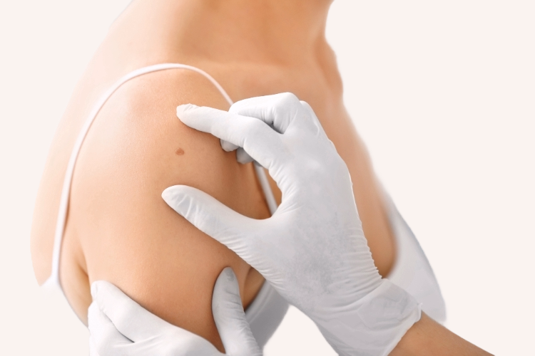 muttermalbehandlung