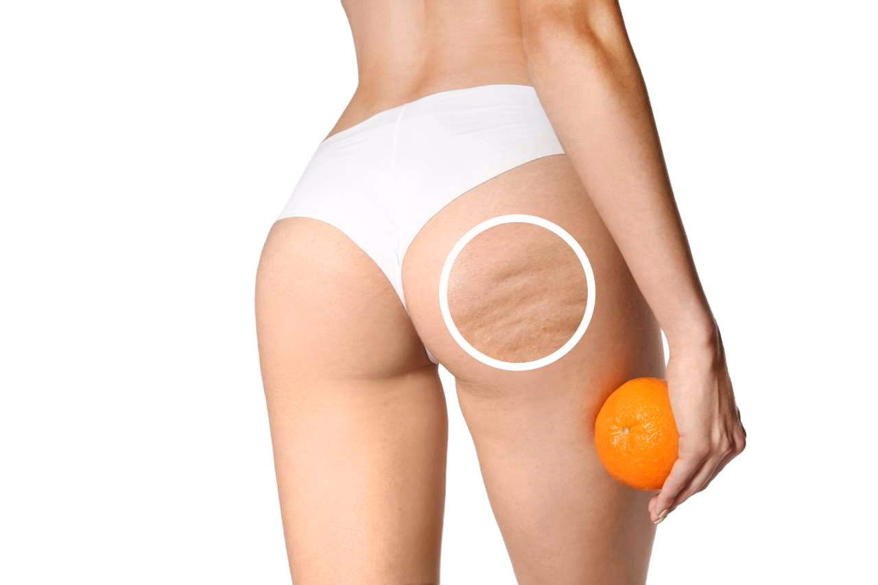 Cellulite
