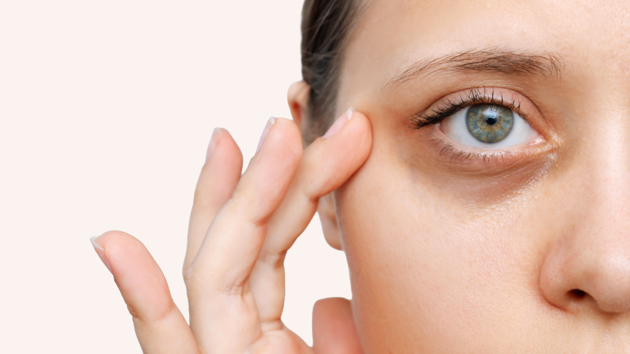 dark circles under the eyes